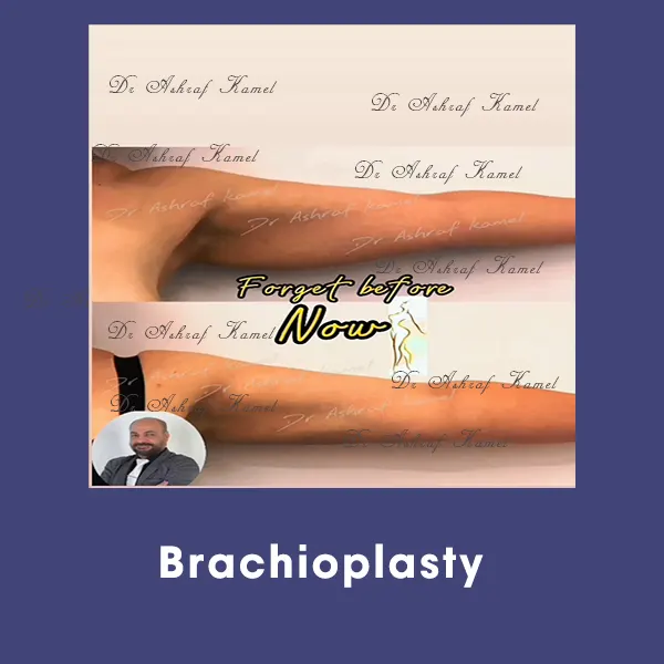 Brachioplasty