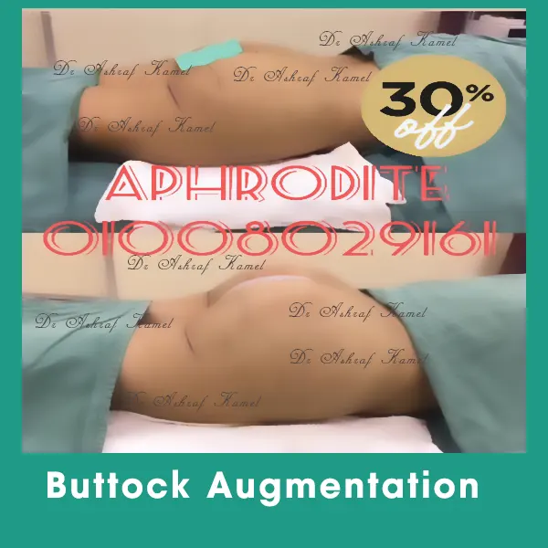 Buttock Augmentation