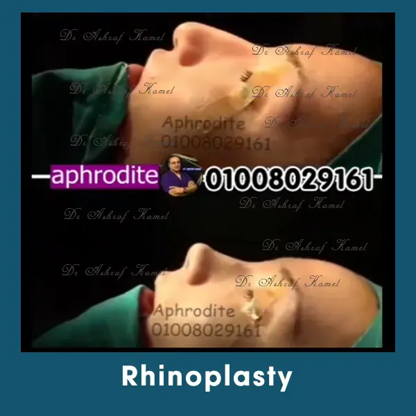 Rhinoplasty