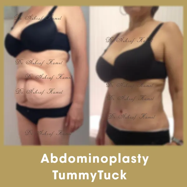 Abdominalplasty