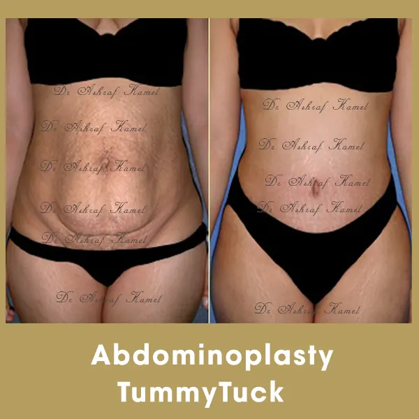 Abdominalplasty